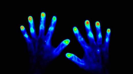 Zdravé ruce (45 vteřin po aplikaci kontrastního barviva)