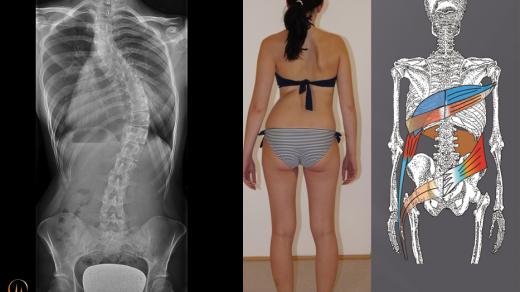 Vlivem skoliózy jsou oslabené svaly mezilopatkové, šikmé břišní a hýžďové