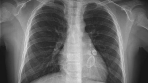 Aneurysma, bublinovitá výduť cévy, je častou komplikací Kawasakiho nemoci. Rentgenový snímek