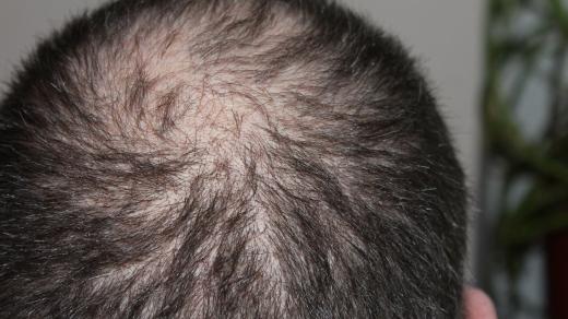 Řídnutí vlasů trápí častěji muže (ilustrační snímek)