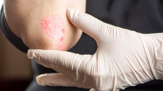 Lupénka, psoriáza, kožní onemocnění, zánět kůže