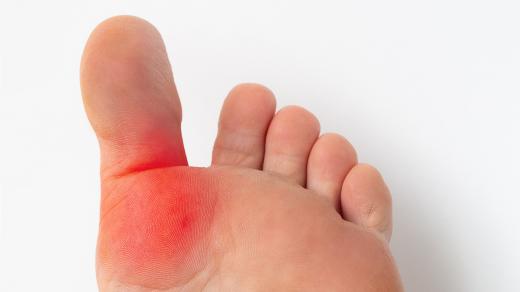 Hallux rigidus: ztuhlý palec nohy