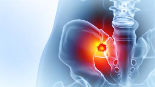 Moci bez nemoci: Gynekologické nádory pánve