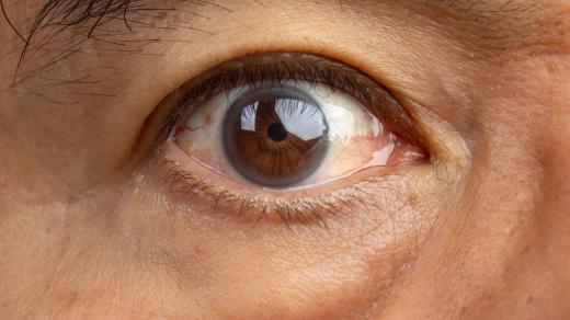 Šedý zákal, odborně zvaný katarakta (ilustrační foto)