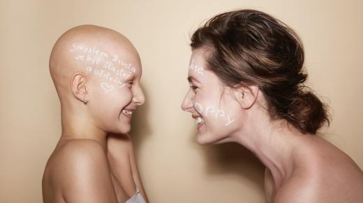 Alopecie postihuje i děti a velmi mladé lidi