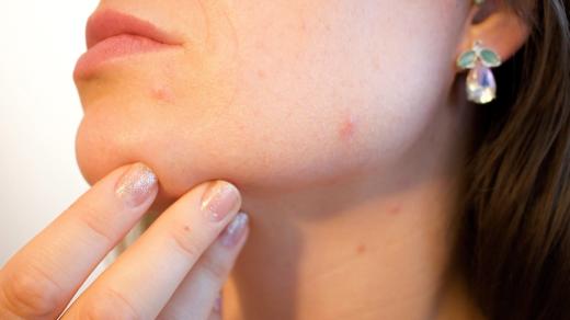 V případě akné je základní prevencí dostatečné, ale nikoli nadměrné čištění pleti.