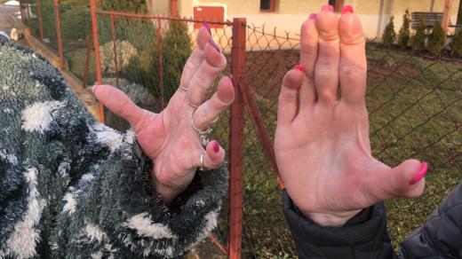 Lidé trpící EDS si z prstů zapletou vánočku. Potíže s bolestmi kloubů a papírovou kůží jsou dědičné