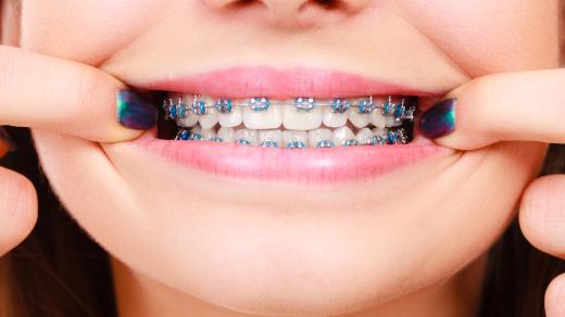 Jak dlouho už lidstvo používá rovnátka?