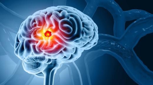 Moci bez nemoci: metoda Optune TTF (Tumor Treating Fields)