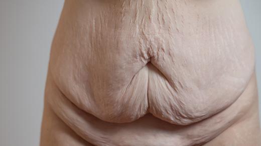 Přebytečná kůže po výrazném zhubnutí