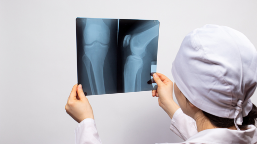 Doktor se dívá na rentgenový snímek kolene