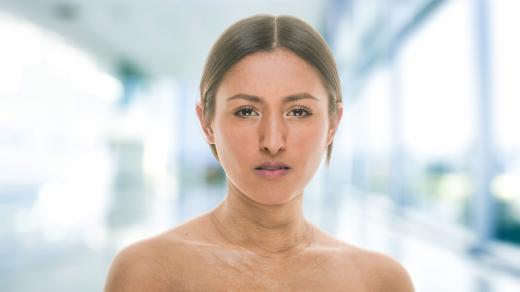 Žena se systémovou sklerodermií